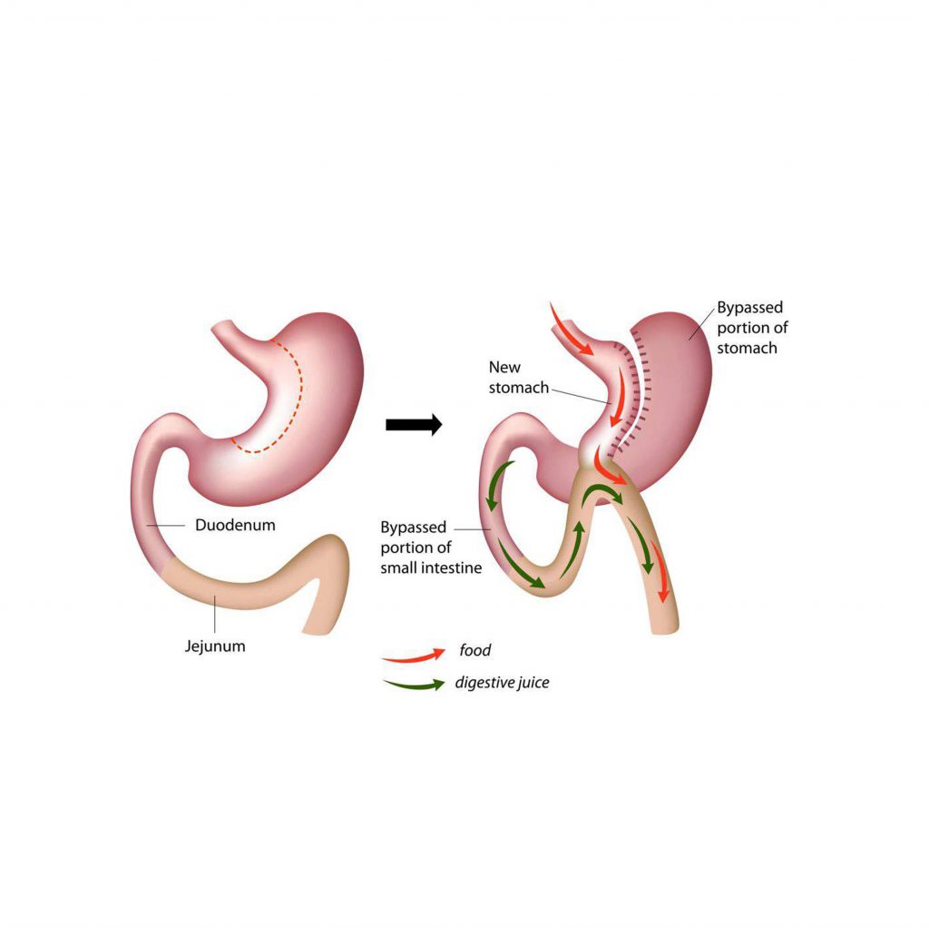 Gastric Bypass – Cosmetic Surgery in México | Cosmetic Surgery México