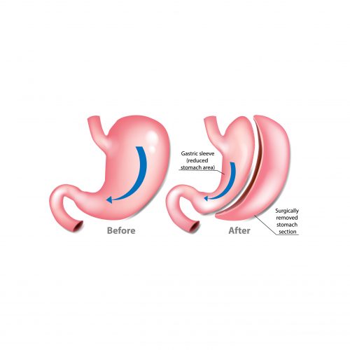 Gastric Sleeve – Cosmetic Surgery in México | Cosmetic Surgery México