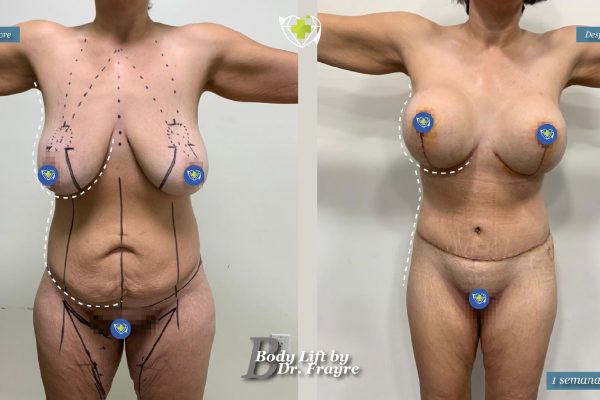 Body-by-dr-frayre-tijuana-cirugia-estetica-1