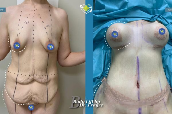 Body-by-dr-frayre-tijuana-cirugia-estetica-8