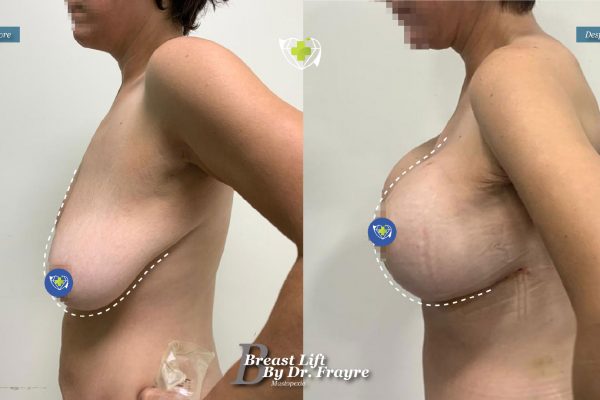 Breast-Lift-dr-frayre-tijuana-cirugia-estetica-3