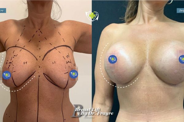Breast-Lift-dr-frayre-tijuana-cirugia-estetica-6