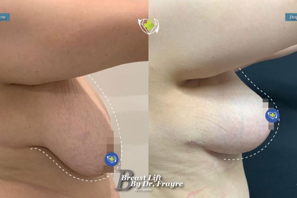 Breast-Lift-dr-frayre-tijuana-cirugia-estetica-7