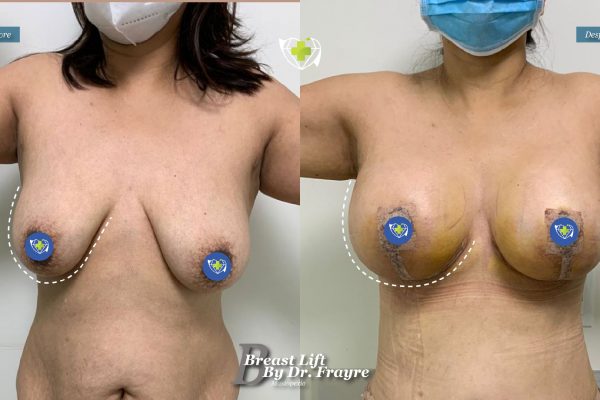 Breast-Lift-dr-frayre-tijuana-cirugia-estetica-8