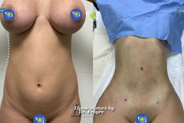 Liposuction-dr-frayre-tijuana-cirugia-estetica-2
