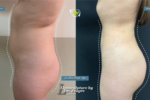 Liposuction-dr-frayre-tijuana-cirugia-estetica-5