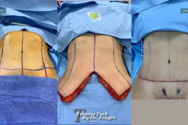 tummy-tuck-dr-frayre-tijuana-cirugia-estetica-6