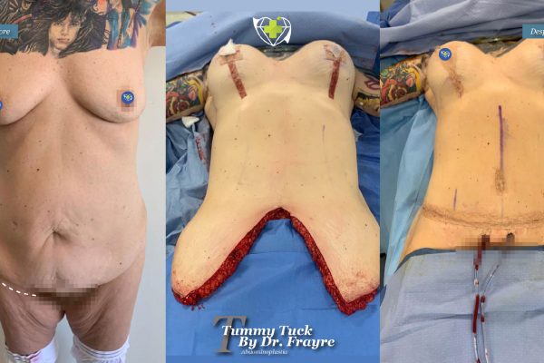 tummy-tuck-dr-frayre-tijuana-cirugia-estetica-7