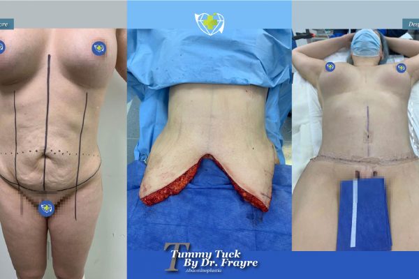 tummy-tuck-dr-frayre-tijuana-cirugia-estetica-8
