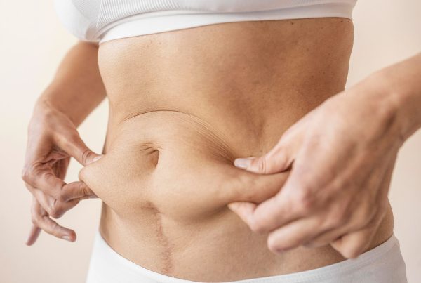 Person showing toned body after weight loss, highlighting improved body contour and skin tightening results.